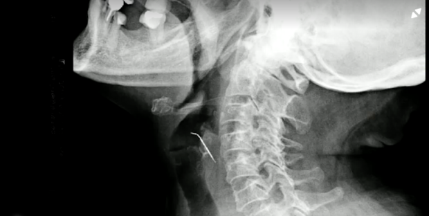 A woman went to the ER thinking she had a bone stuck in her throat. It was a nail piercing her artery.