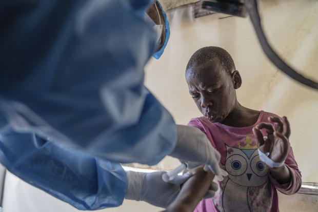 Congo finally begins mpox vaccinations in a drive to slow outbreaks