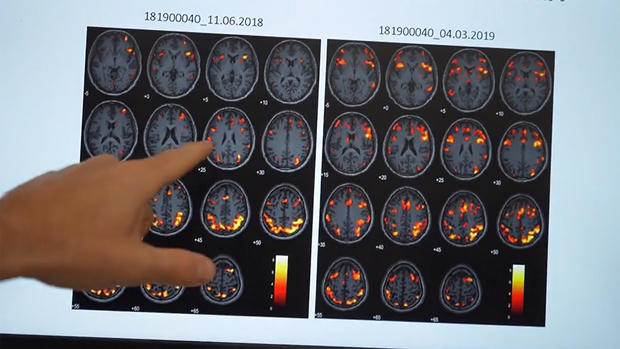 A promising new treatment for PTSD